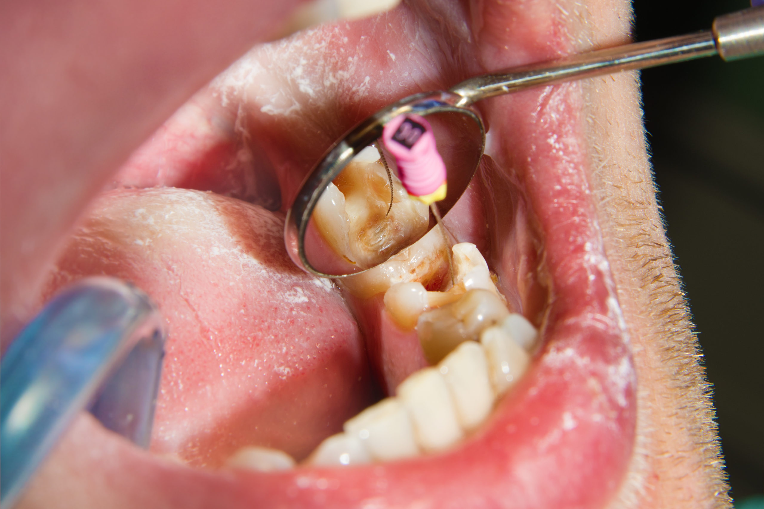 How Long Does It Take for a Root Canal Procedure  
