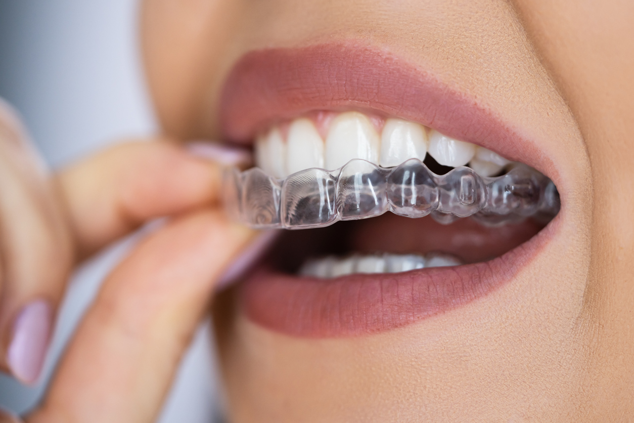 How Long Do Invisible Braces Take?