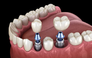 model of dental implant installation