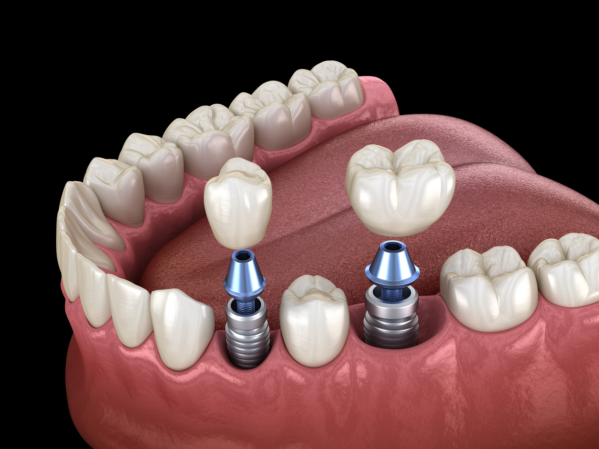 model of dental implant installation