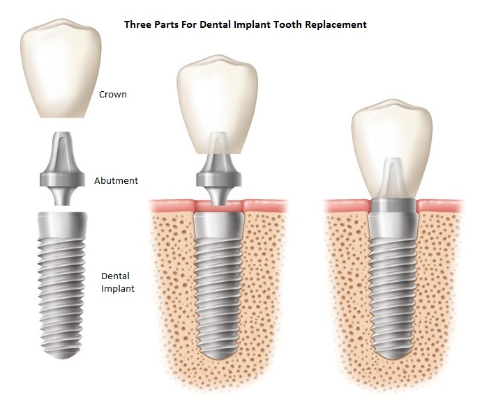 dental implant diagram - Creekview Dental